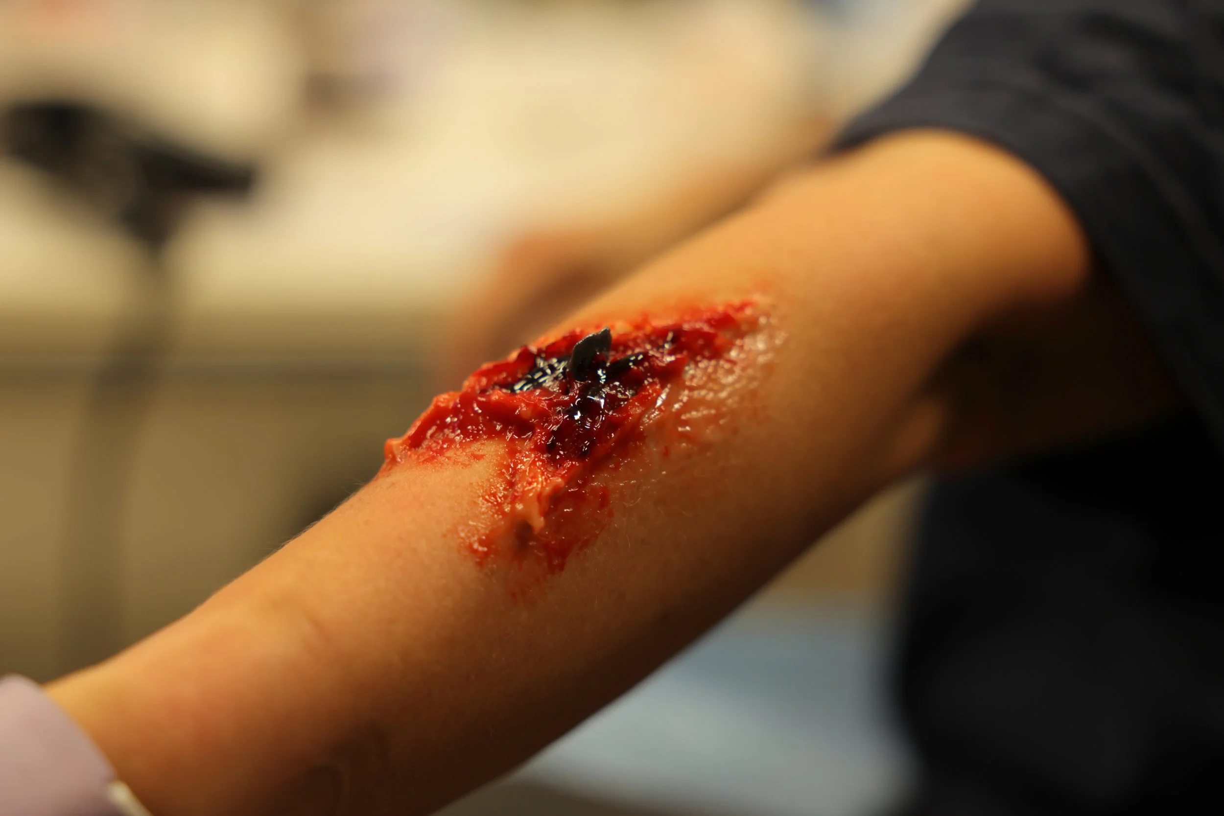 Close-up of a person's arm with a fresh, deep wound with exposed tissue and blood.