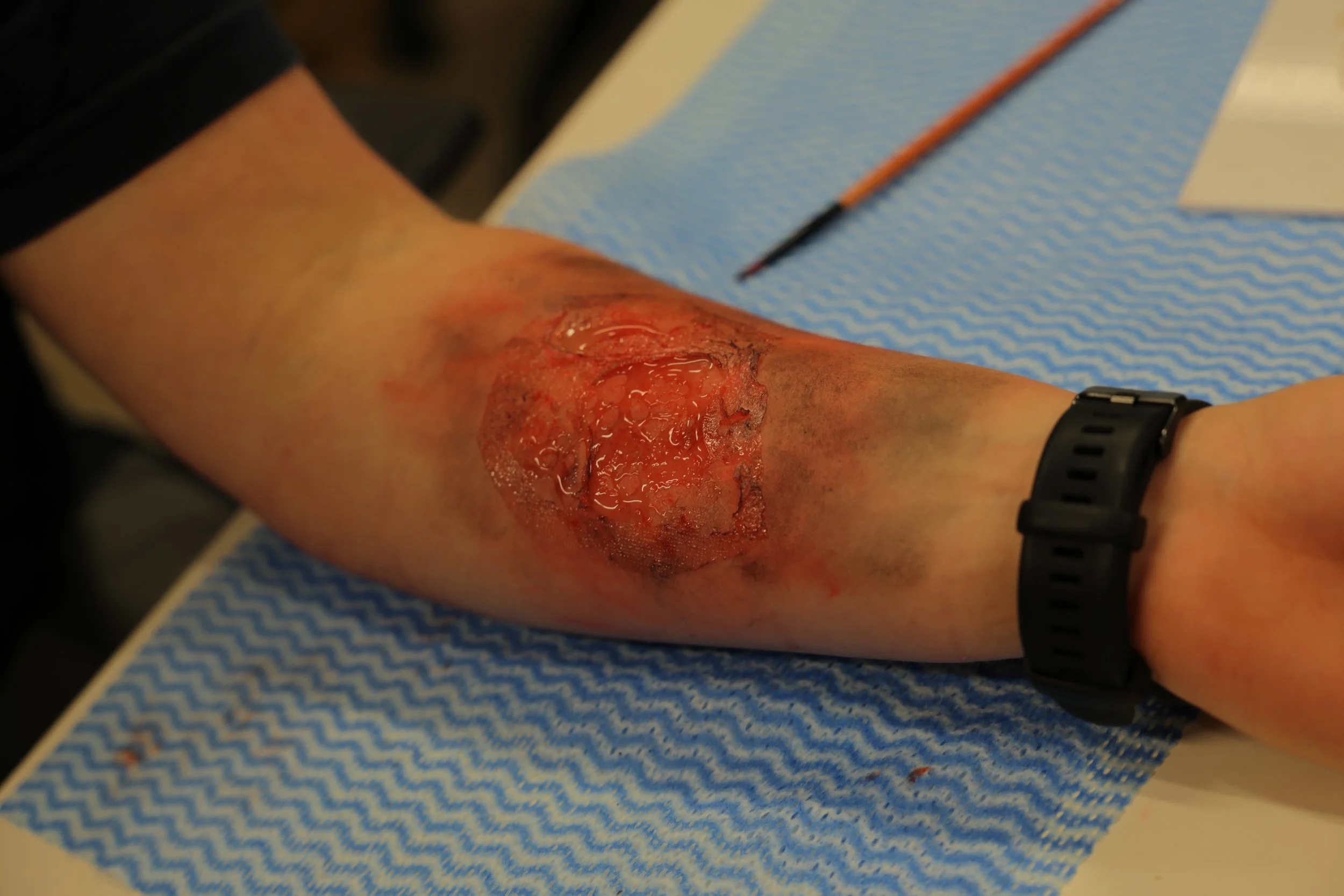 Simulated thermal injury used to assess wound recognition and prioritisation