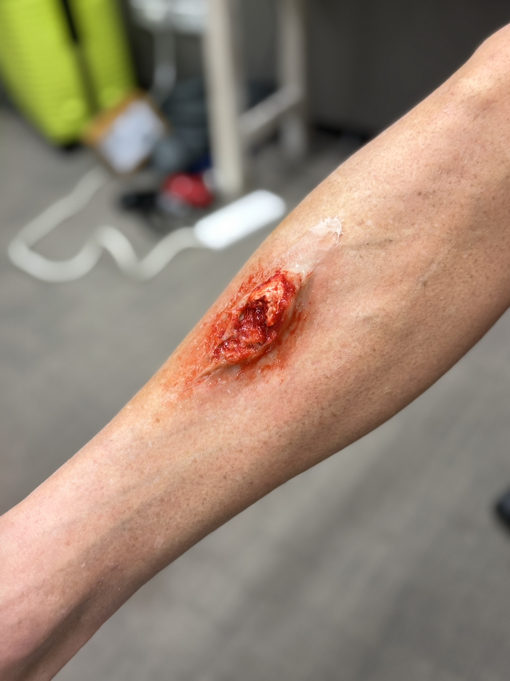A person's arm with a severe, open wound and visible tissue. The background shows a blurred indoor setting with objects like a yellow caution tape, a white power strip, and some containers.