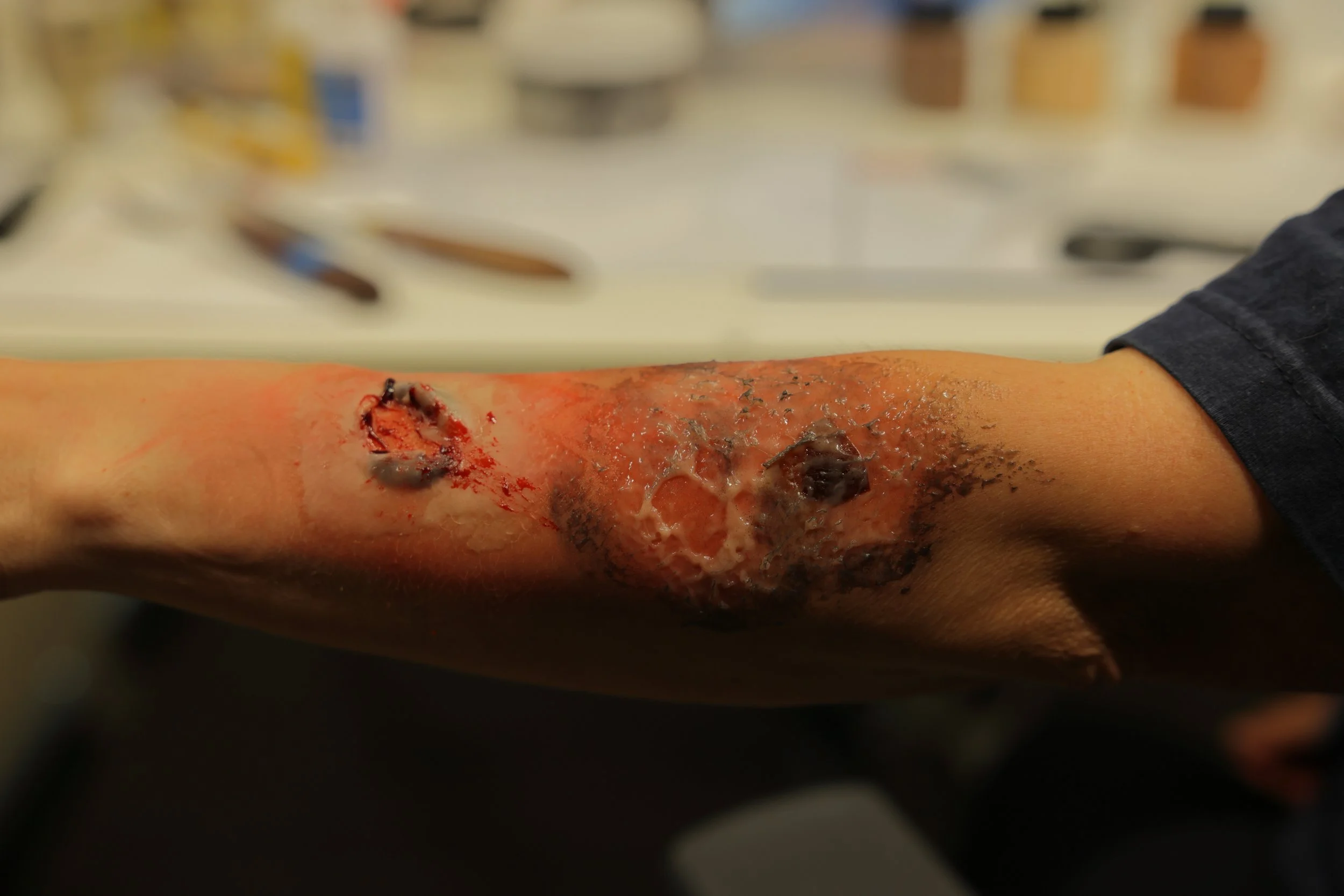 A person's arm with severe burn injuries, including open wounds, blistering, and blackened skin.