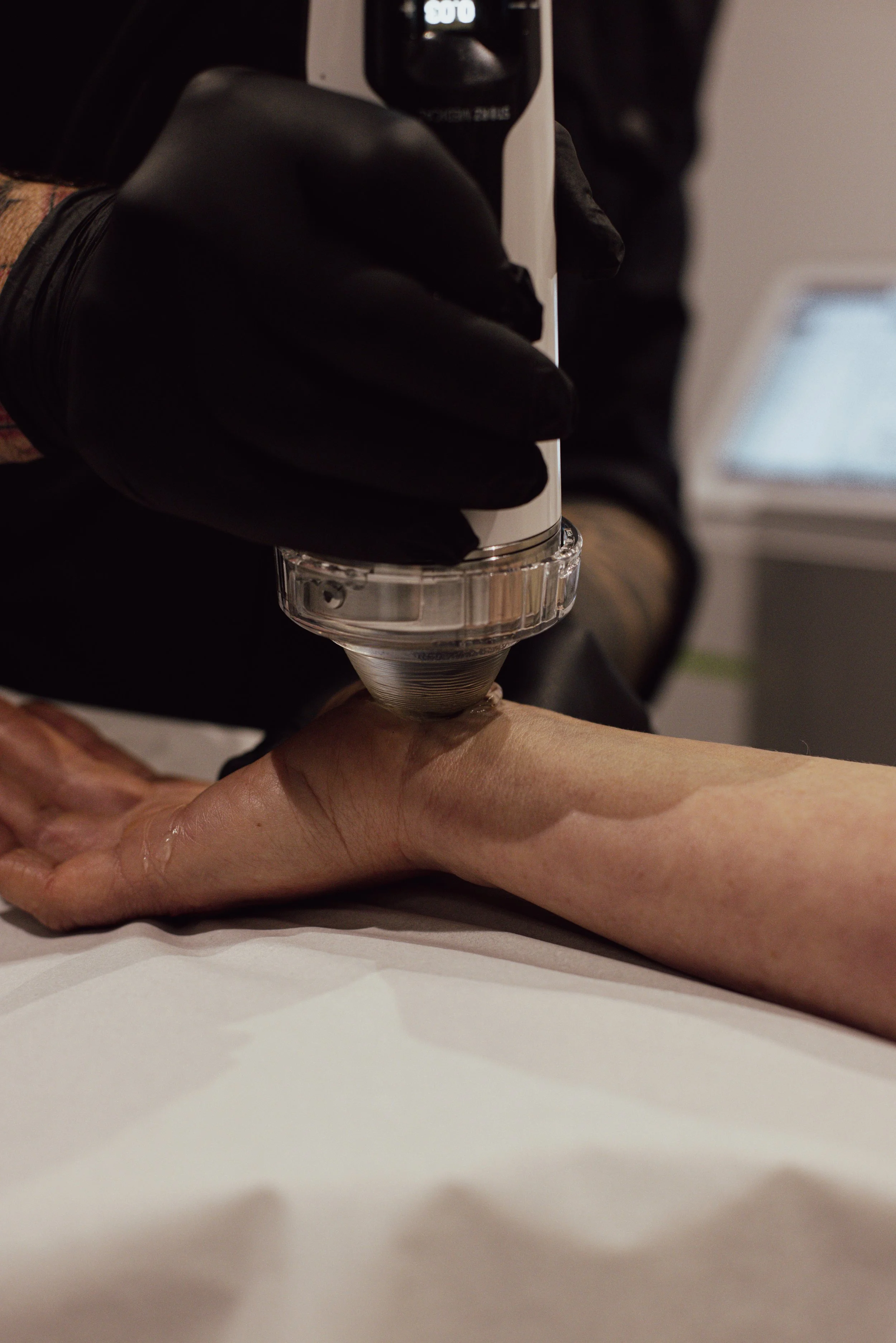 A person receiving focused shockwave therapy treatment on their wrist. The person is lying down, and the technician is wearing black gloves and holding the device.