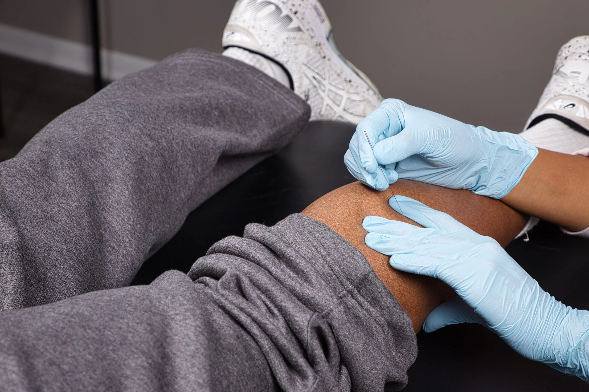 A healthcare professional wearing blue gloves doing dry needling on a person's leg.
