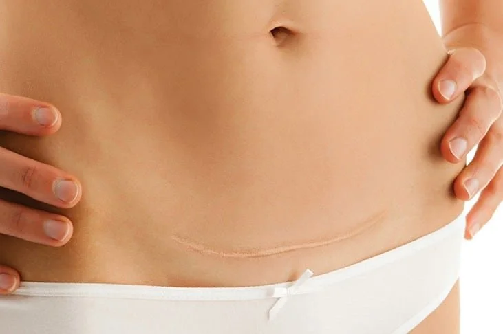 cicatrice-cesarienne.jpg