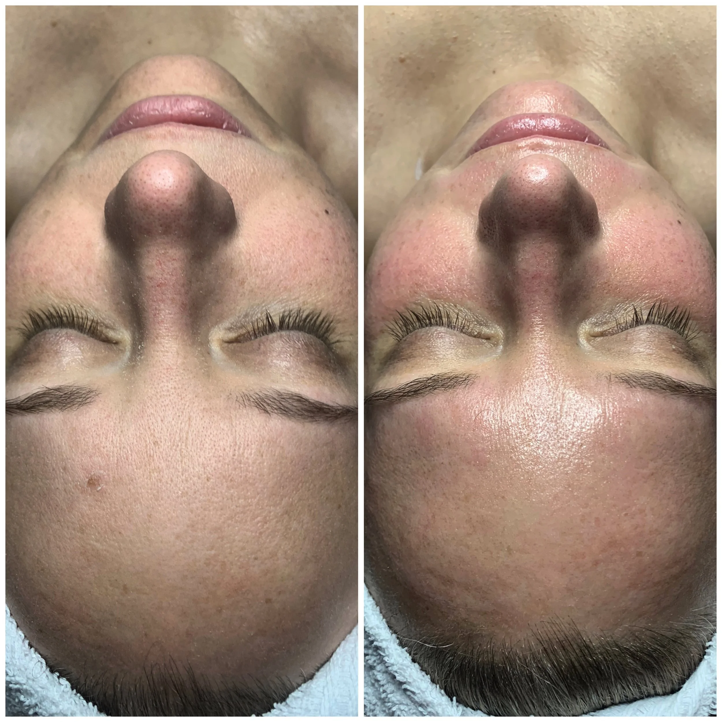 Side-by-side comparison of a person's face before and after a skincare treatment, showing improved skin texture and pore appearance.