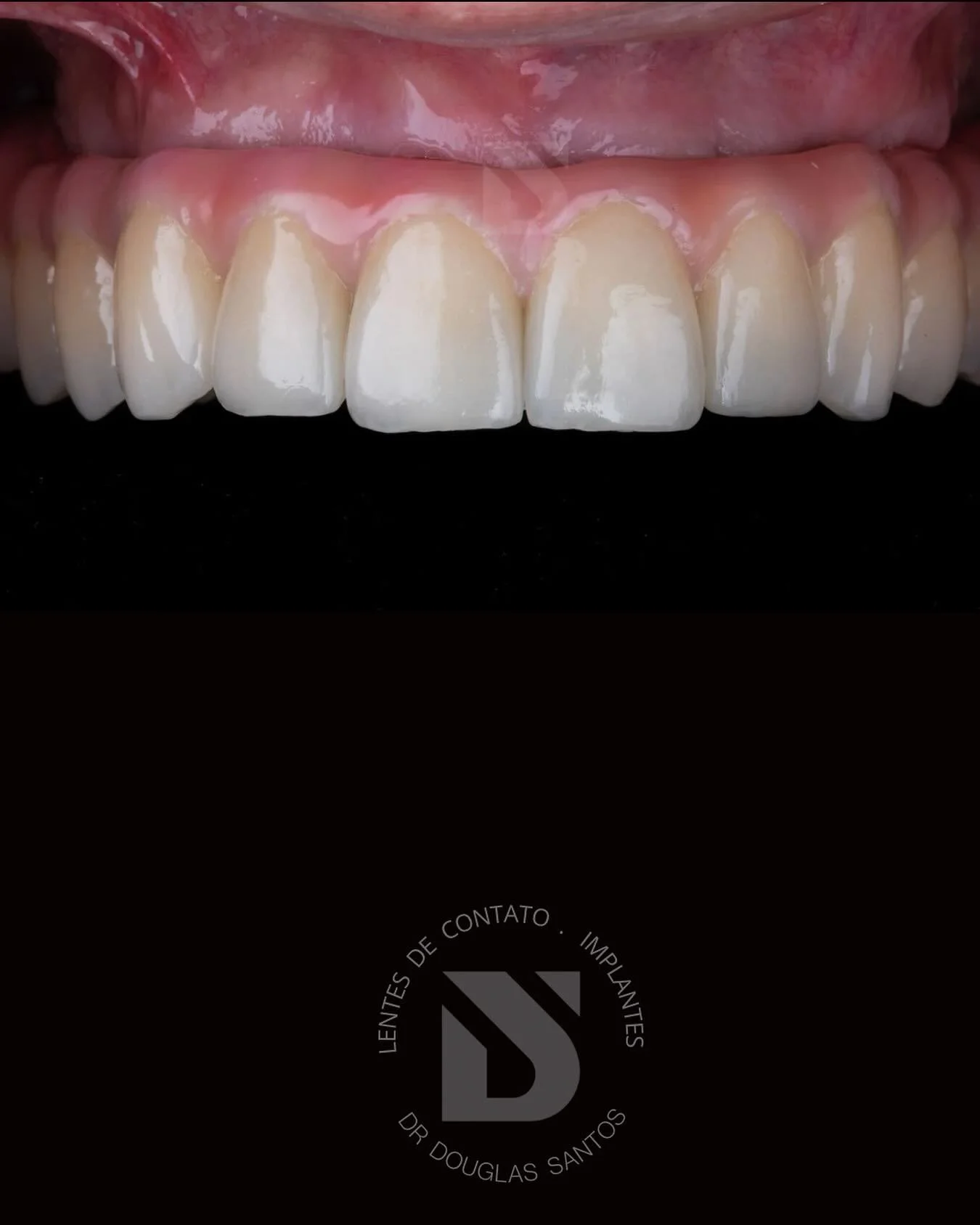 Adeus, Pr&oacute;tese M&oacute;vel. Ol&aacute;, Protocolo Fixo! 
Protocolo sobre Implantes: A solu&ccedil;&atilde;o definitiva para quem busca dentes fixos, estabilidade total e um sorriso est&eacute;tico, eliminando o desconforto da pr&oacute;tese t