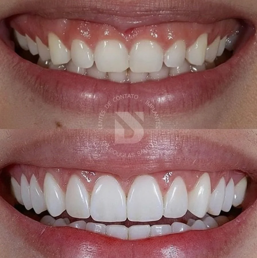 Fechei o meu ano com este caso.

Trata-se de uma paciente que se sentia incomodada com o sorriso com apar&ecirc;ncia infantil: dentes curtos, muita gengiva aparecendo e formato que n&atilde;o combinava com a imagem que ela desejava transmitir. Isso i