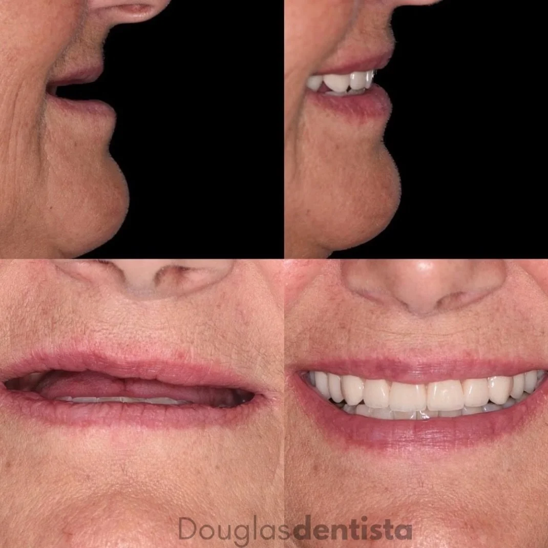 Muito al&eacute;m de dentes, o Protocolo &eacute; sobre devolver a arquitetura da face. Observem como a aus&ecirc;ncia dent&aacute;ria faz o l&aacute;bio &lsquo;perder o suporte&rsquo; e envelhecer o perfil (primeira imagem).

Atrav&eacute;s de um bo