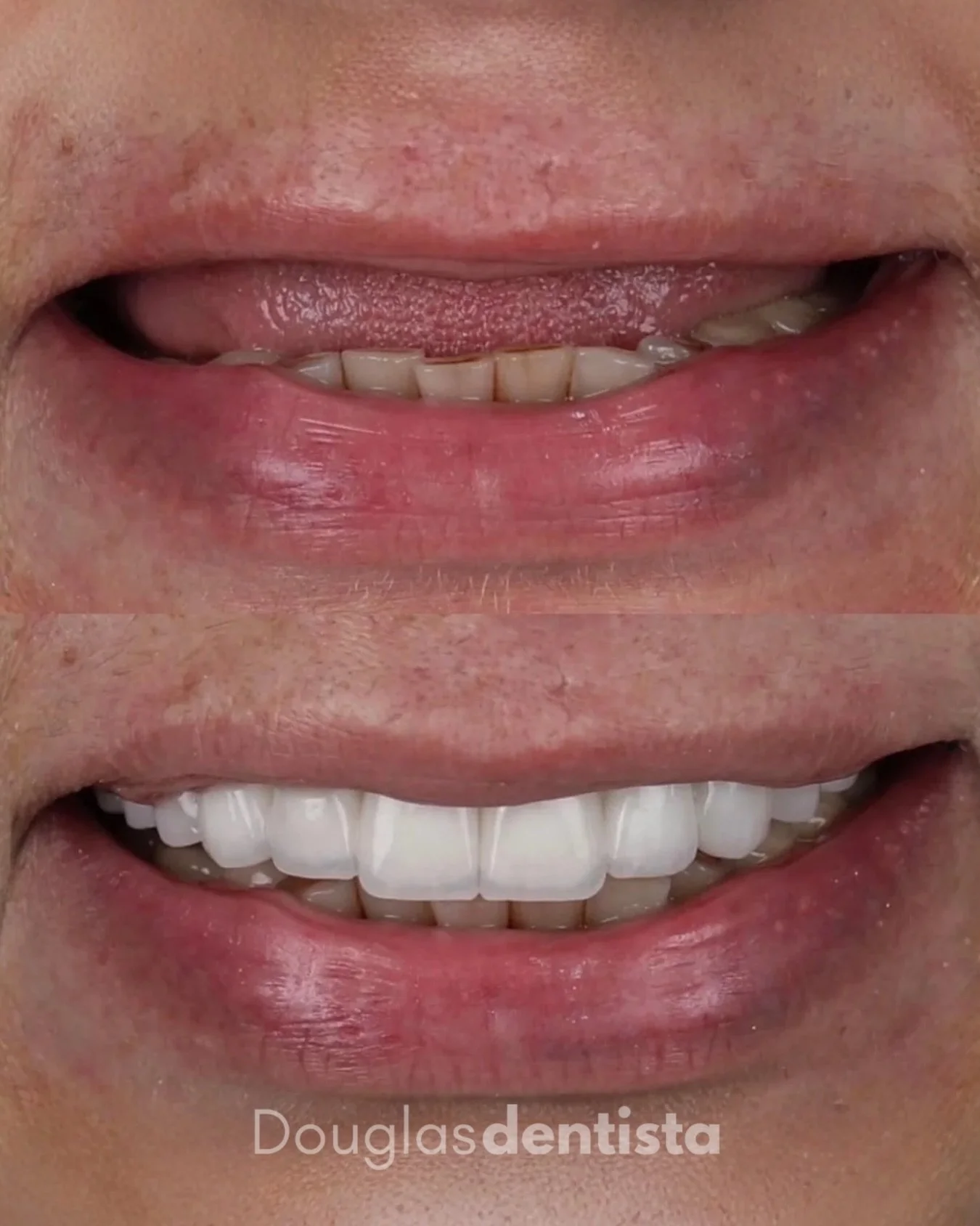 Com o passar dos anos, &eacute; natural perdermos estrutura dent&aacute;ria, o que reflete diretamente no volume dos l&aacute;bios e na sustenta&ccedil;&atilde;o da face. Quando devolvemos o comprimento e a posi&ccedil;&atilde;o correta dos dentes, o