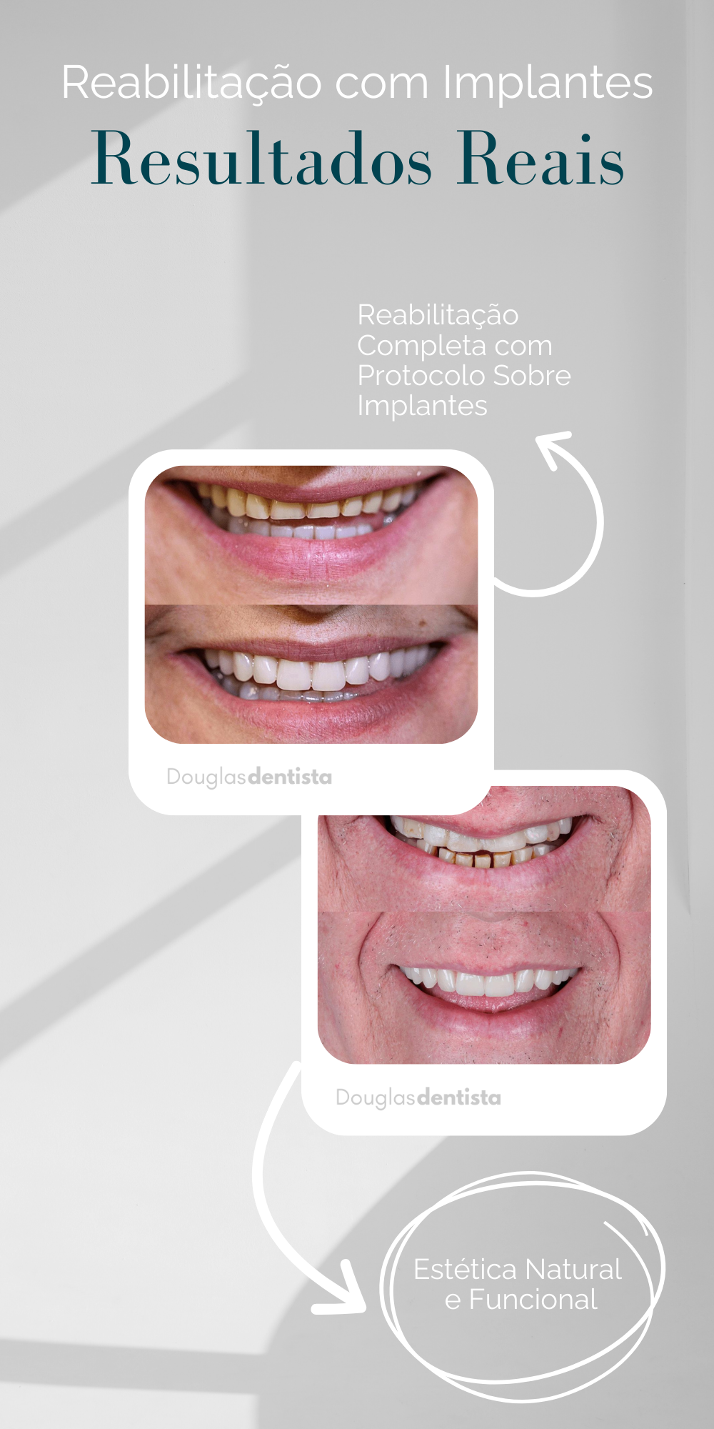 Resultado real de implante dentário realizado pelo Dr. Douglas. Foto de antes e depois devolvendo a estética e a função mastigatória ao paciente.