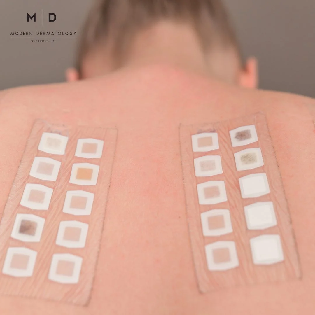 Close-up of a person's upper back showing four acupuncture or dry needling patches with multiple small square pads attached to their skin.