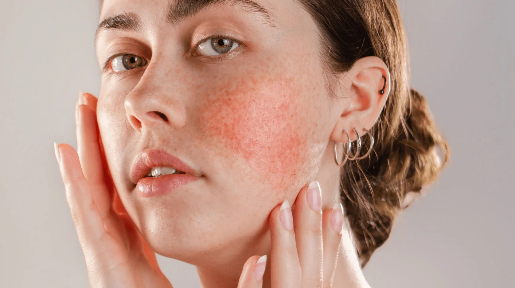 Close-up of a young woman with freckles touching her face with both hands, showing redness and irritation on her cheek.