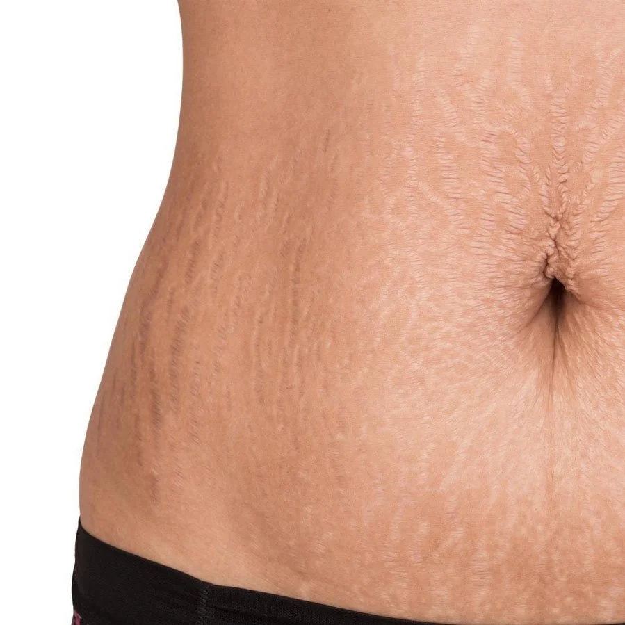Close-up of human abdomen showing stretch marks and navel.
