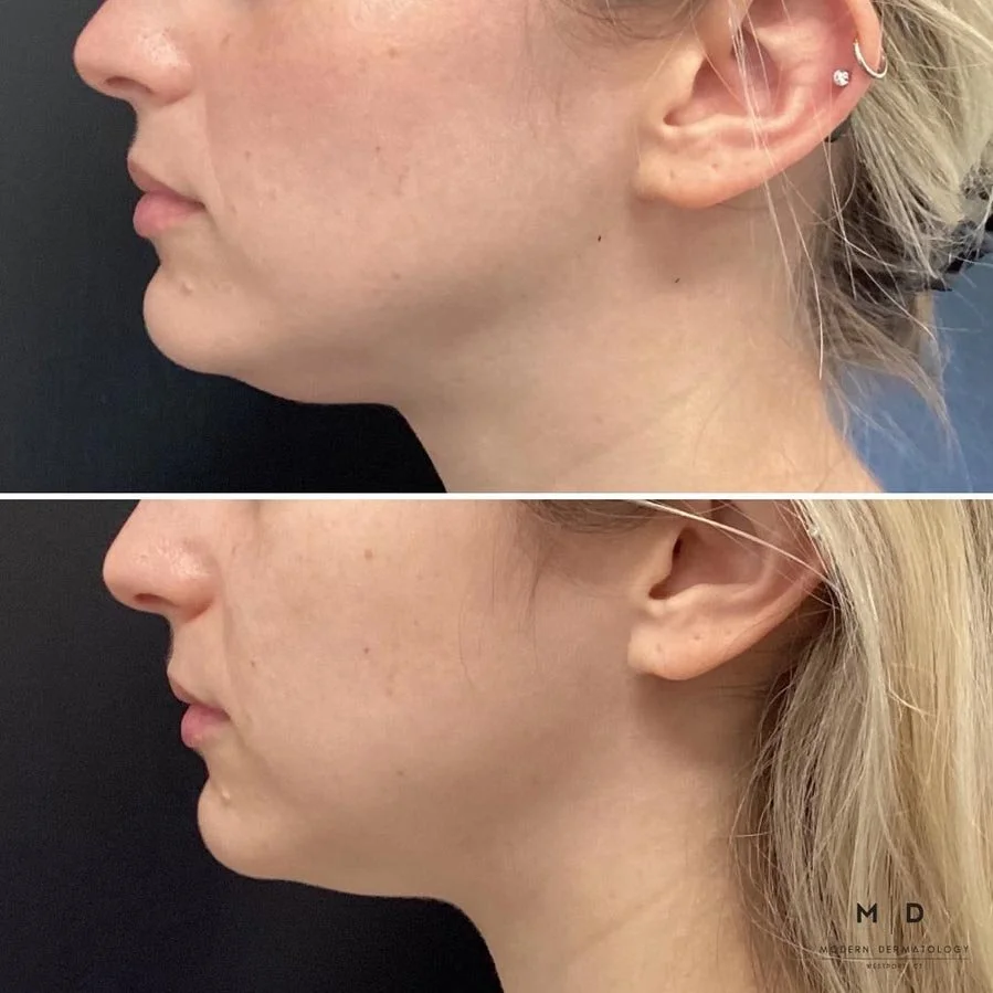 Side-by-side comparison of a woman's face showing before and after skin treatment, highlighting smoother skin and improved skin tone in the after photo.
