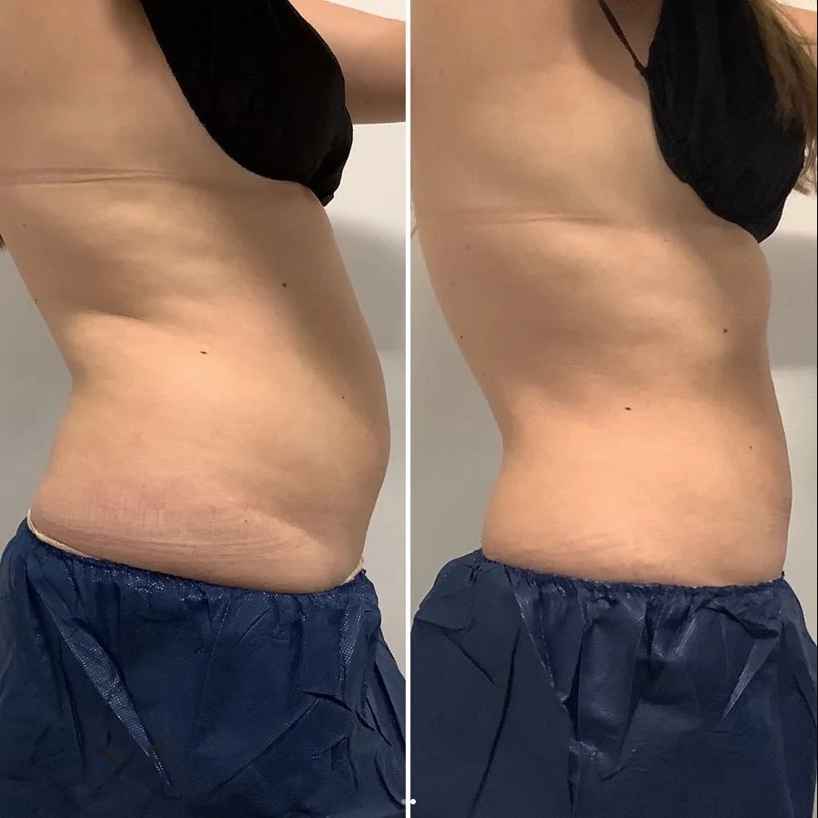 Side-by-side comparison of a woman's abdomen before and after weight loss or body change, showing a reduction in abdominal size.
