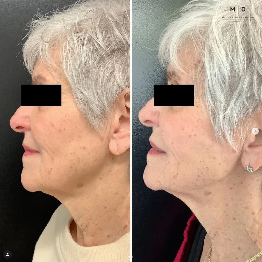 Side-by-side comparison of a woman before and after a dermatological treatment, showing improved skin texture and reduced age spots.
