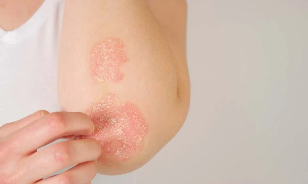 A person with psoriasis scars on their arm, with a hand gently touching one of the patches.