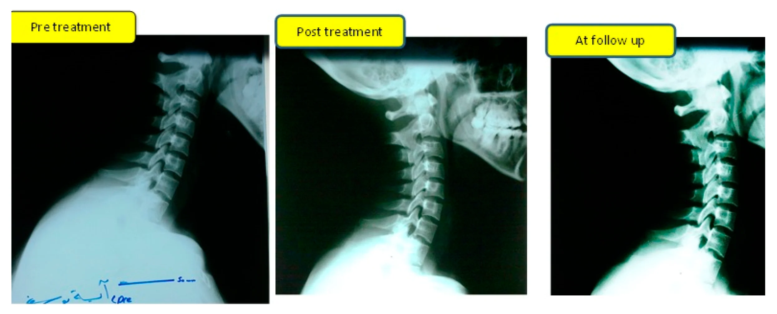 Three cervical spine X-rays from a 2022 randomized controlled trial showing pre-treatment loss of cervical lordosis, post-treatment improvement, and maintained correction at six-month follow-up