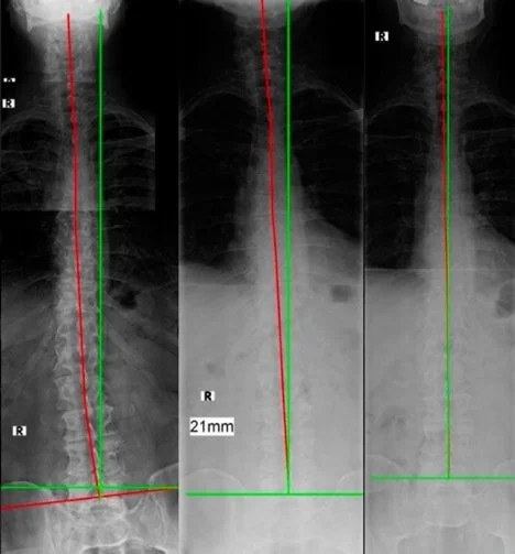 Left shows leg length inequality with structural abnormality, middle shows corrected leg length with lift and persistent structural abnormality, right shows precision structural correction