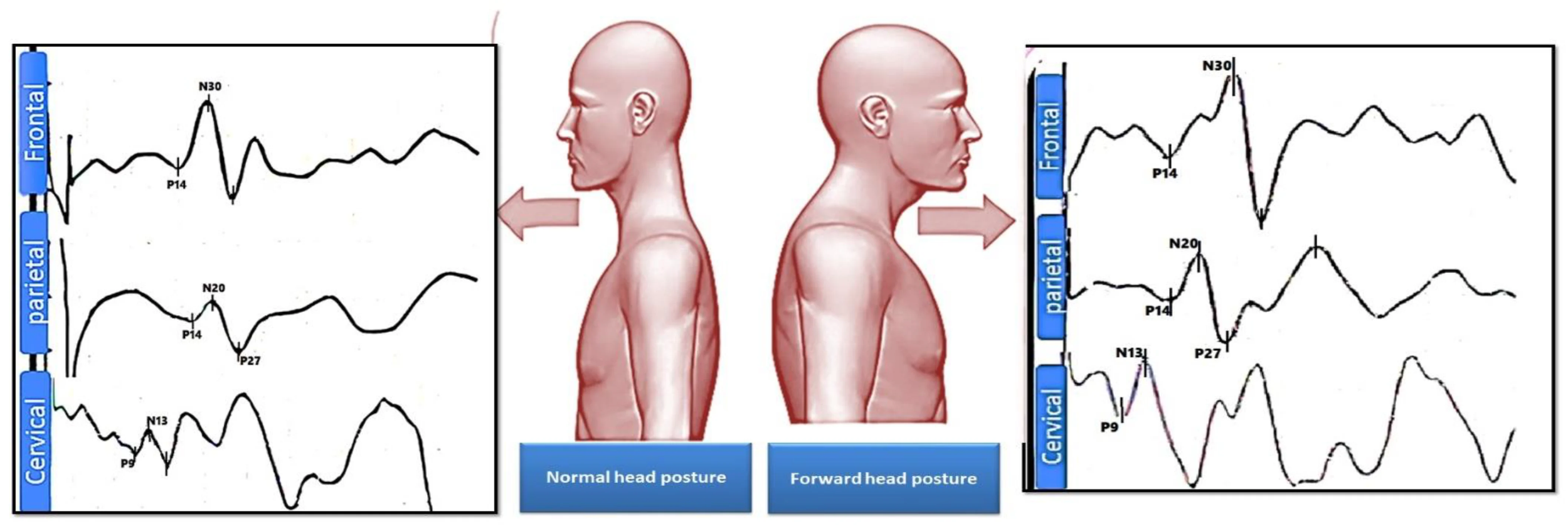 Left demonstrates normal electrical impulse from no neurologic obstruction (Normal Head Posture), image on the right demonstrates irregular chaotic impulse associated with neurologic obstruction (Forward Head Posture).