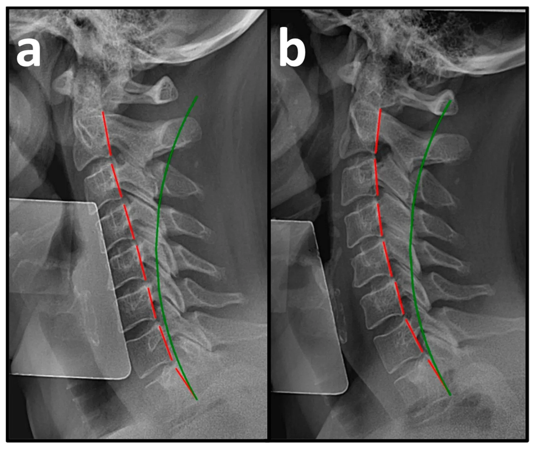 🚨 NEW RESEARCH CHALLENGES WHIPLASH RECOVERY TIMELINE 🚨

For years, we've been told: "If you're not better by 3 months after whiplash, you won't get better."

A new multicenter study of 51 patients suggests this is actually FALSE... IF you