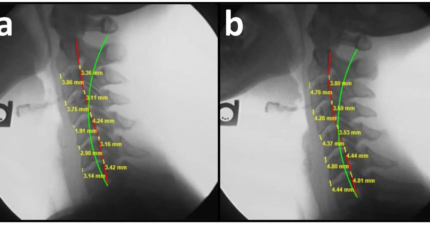 🚨 &ldquo;YOUR DISC DEGENERATION IS NOT PERMANENT&rdquo; 🚨

Have you been told the opposite?

New research on 64 patients with cervical degenerative disc disease shows something remarkable:
Disc heights INCREASED by 36-41% after restoring cervical s