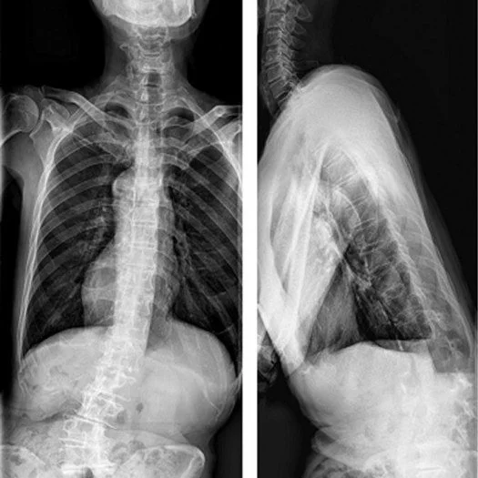 New research in Clinical Biomechanics journal sheds light on what structural chiropractors have long understood: spinal deformity goes beyond pain into how the body truly functions, in this case balance.

A 2026 systematic review of 22 studies found 