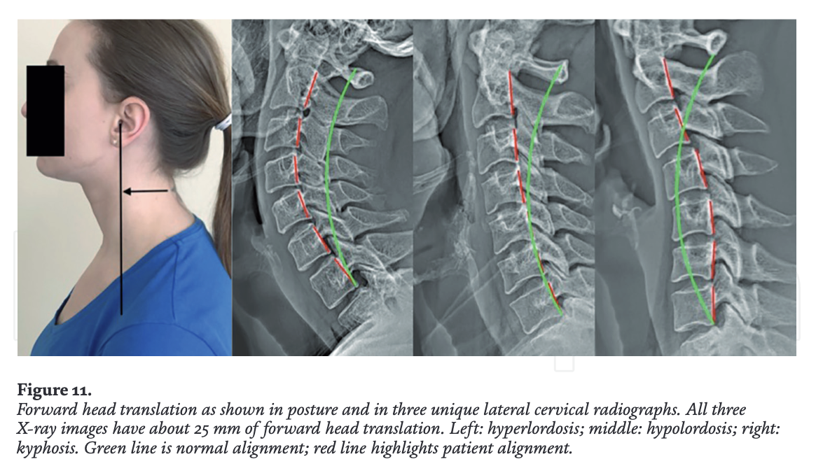 Side posture photo and three lateral cervical x-rays showing 25 mm of forward head translation with different neck curve shapes