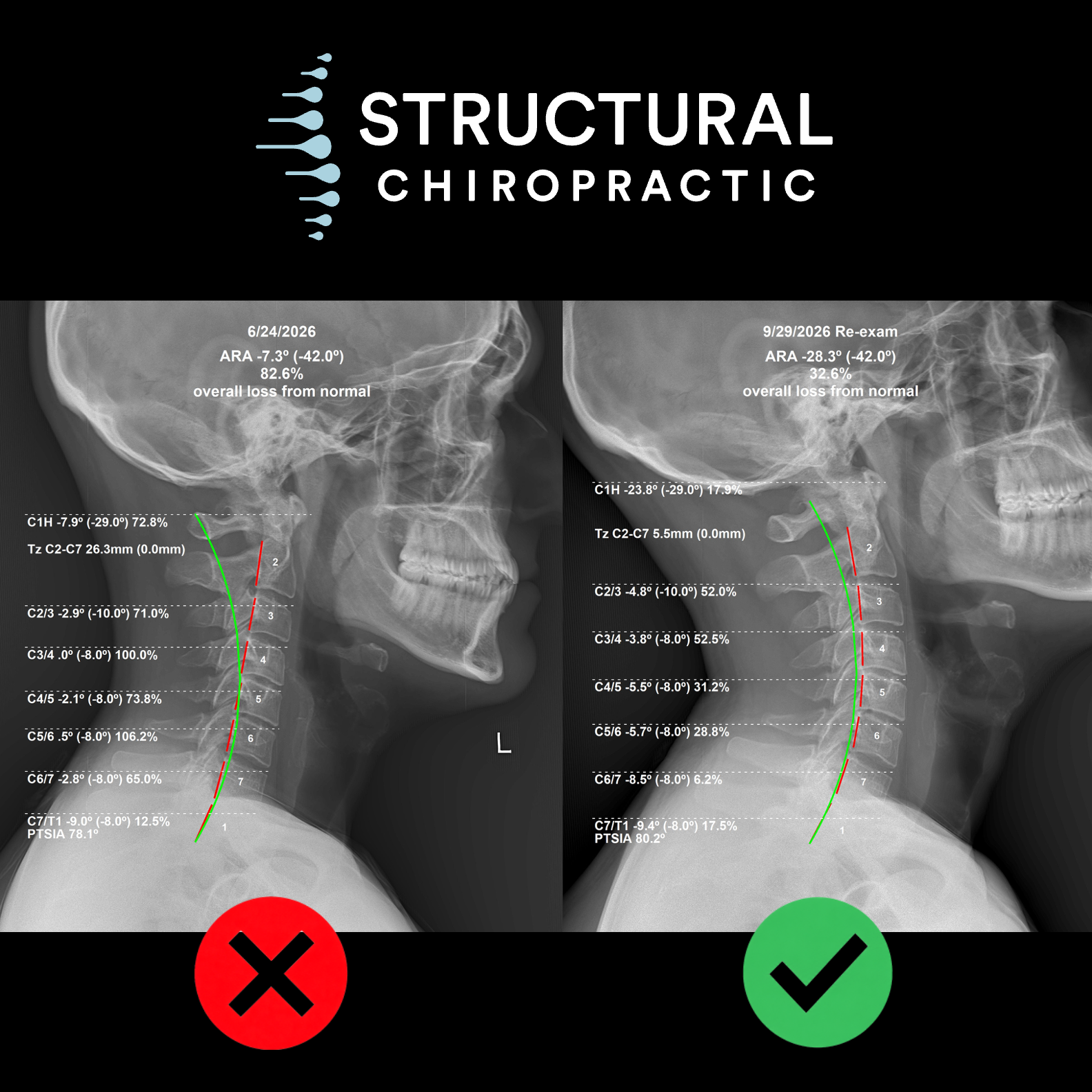 Before and after lateral cervical x-rays showing the neck curve improving from 7.3 to 28.3 degrees and forward head translation from 26.3 to 5.5 mm