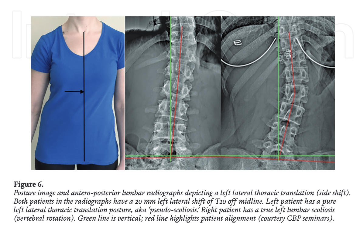 Posture photo and two AP radiographs comparing a left lateral thoracic translation (pseudoscoliosis) with a true left lumbar scoliosis