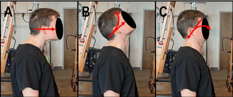 Three-step Fedorchuk Lordosis Improving Procedure (FLIP): A) head forward, B) head tipped back, C) retraction with chin tuck to restore cervical curve. Photo from Haas et al. 2024 (PMID: 39417063)