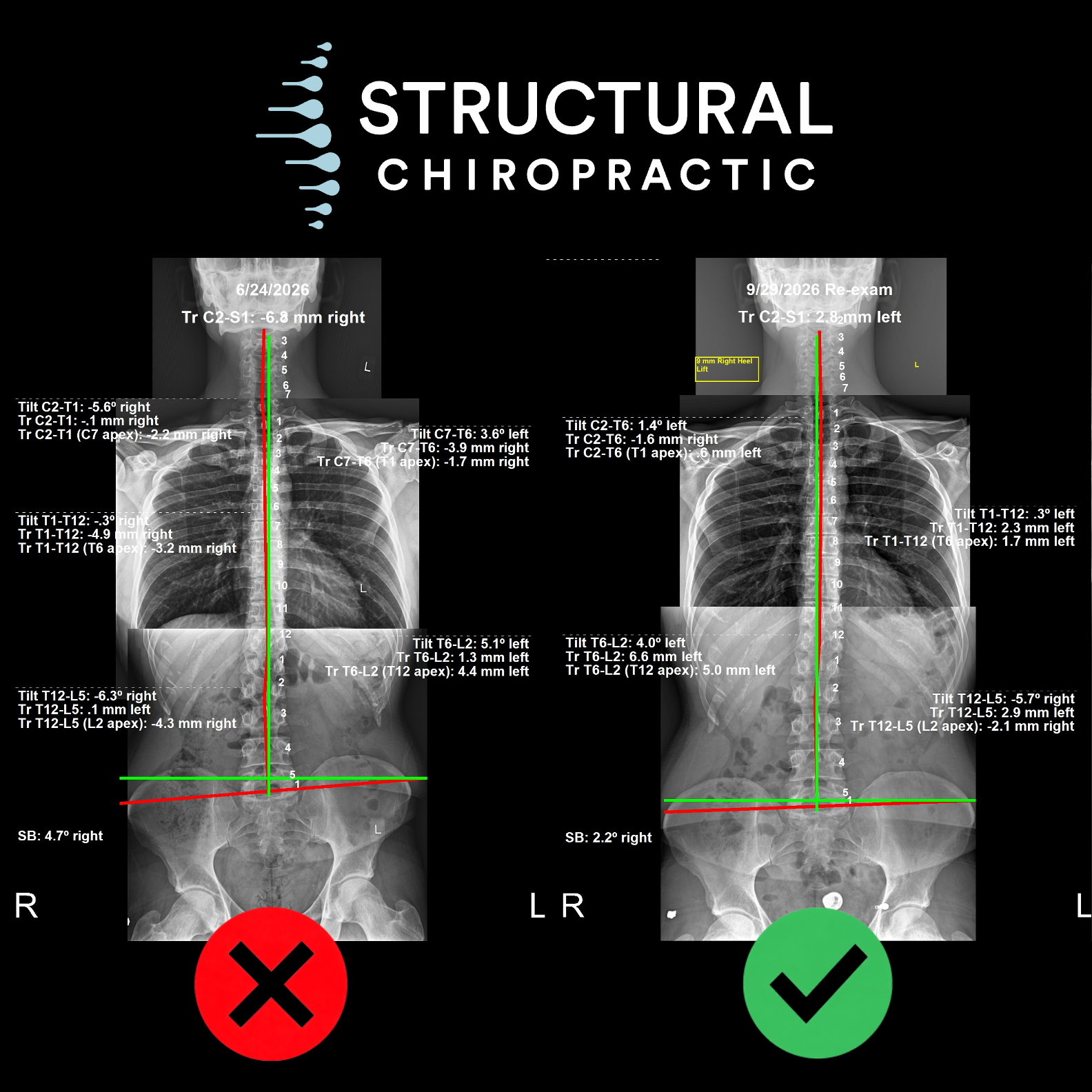 Before and after full-spine x-rays with measured tilt and translation values showing improved spinal alignment after three months of care