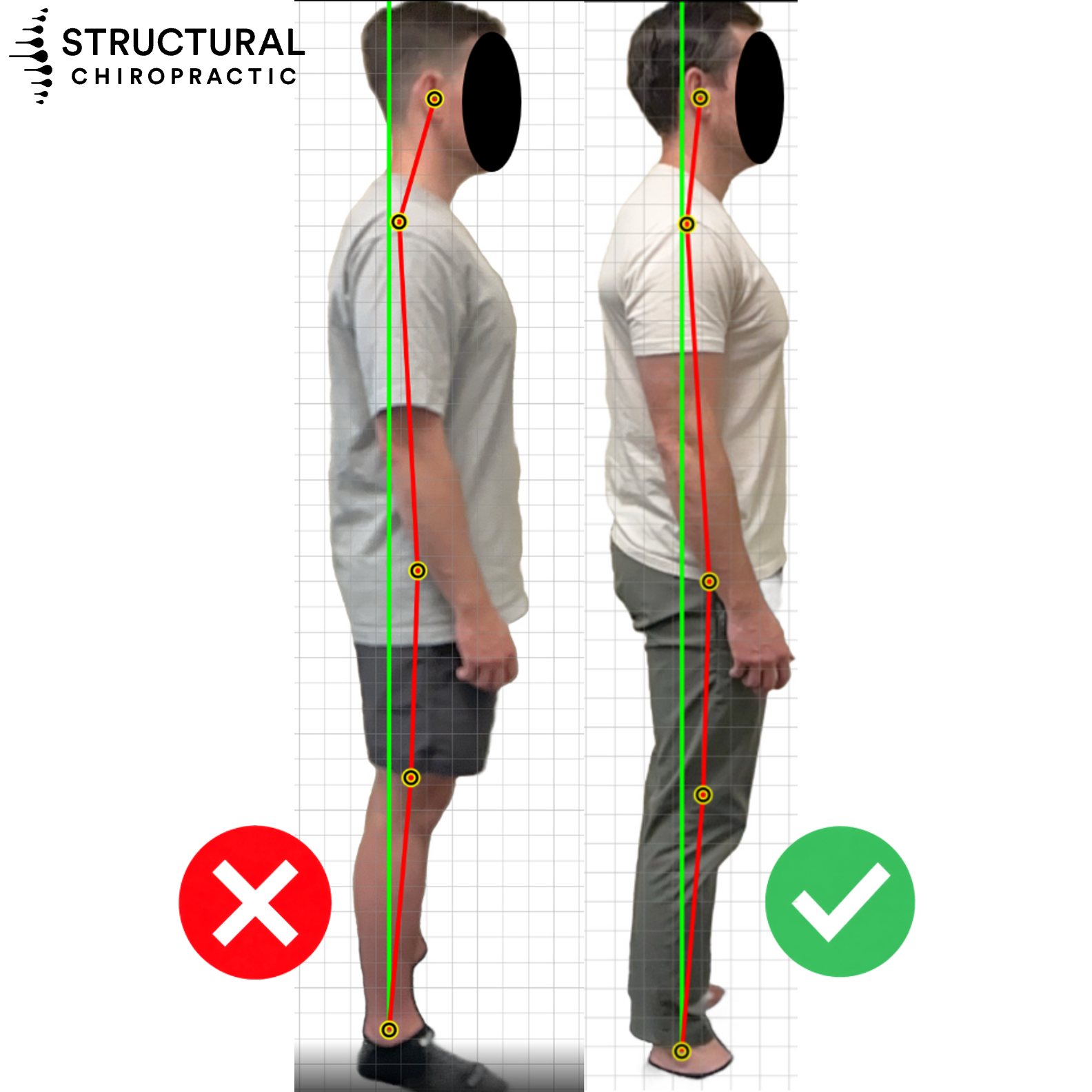 Before and after side posture photos with plumb lines showing the head and body moving closer to vertical alignment after structural correction
