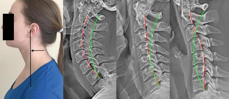 Various examples of structural abnormalities associated with forward head posture as seen on digital radiography (x-ray), green line represents normal alignment, red line represents patient's alignment.