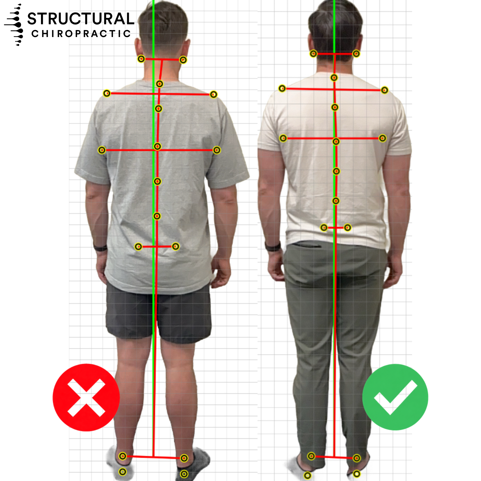 Before and after rear posture photos with alignment markers showing improved head, shoulder, and pelvic symmetry after structural correction
