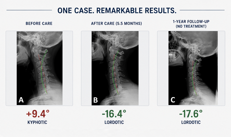 Three cervical X-rays showing before care at plus 9.4 degrees kyphotic, after 5.5 months of care at minus 16.4 degrees lordotic, and one year follow-up at minus 17.6 degrees lordotic