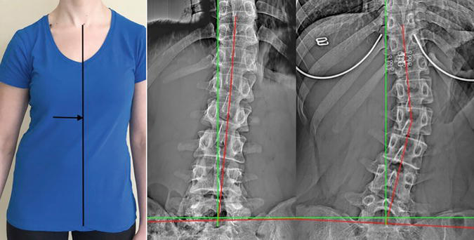 Various examples of structural abnormalities associated with left trunk list as seen on digital radiography (x-ray), green line represents normal alignment, red line represents patient's alignment.