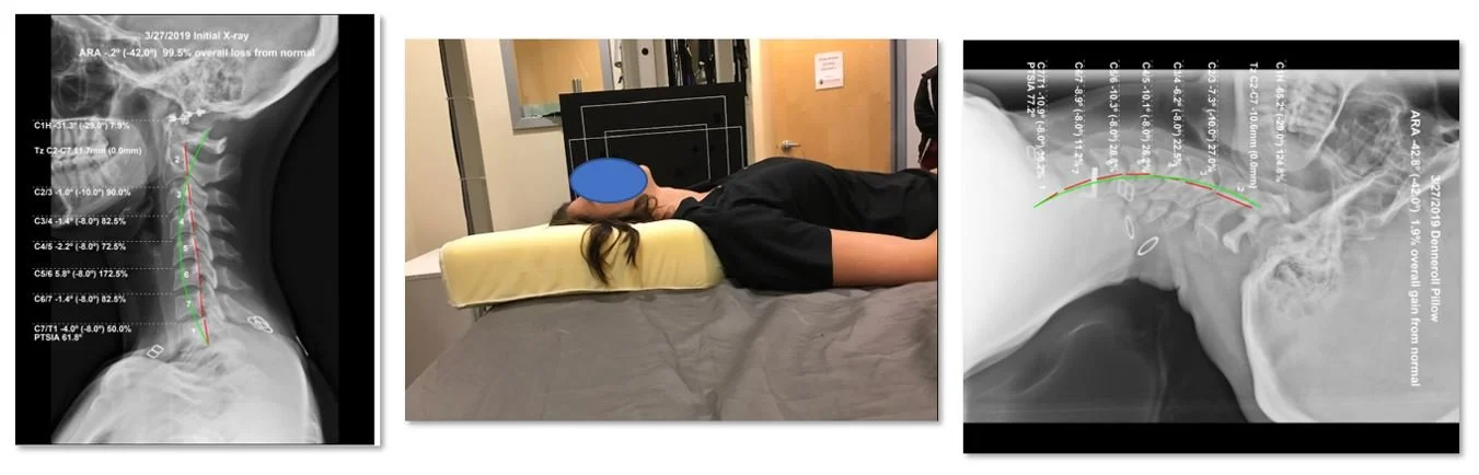 Side-by-side clinical images showing initial cervical X-ray with 99.5% loss of lordosis, patient positioned on the Denneroll Pillow, and follow-up X-ray showing 1.9% gain in cervical curve from normal after Denneroll use