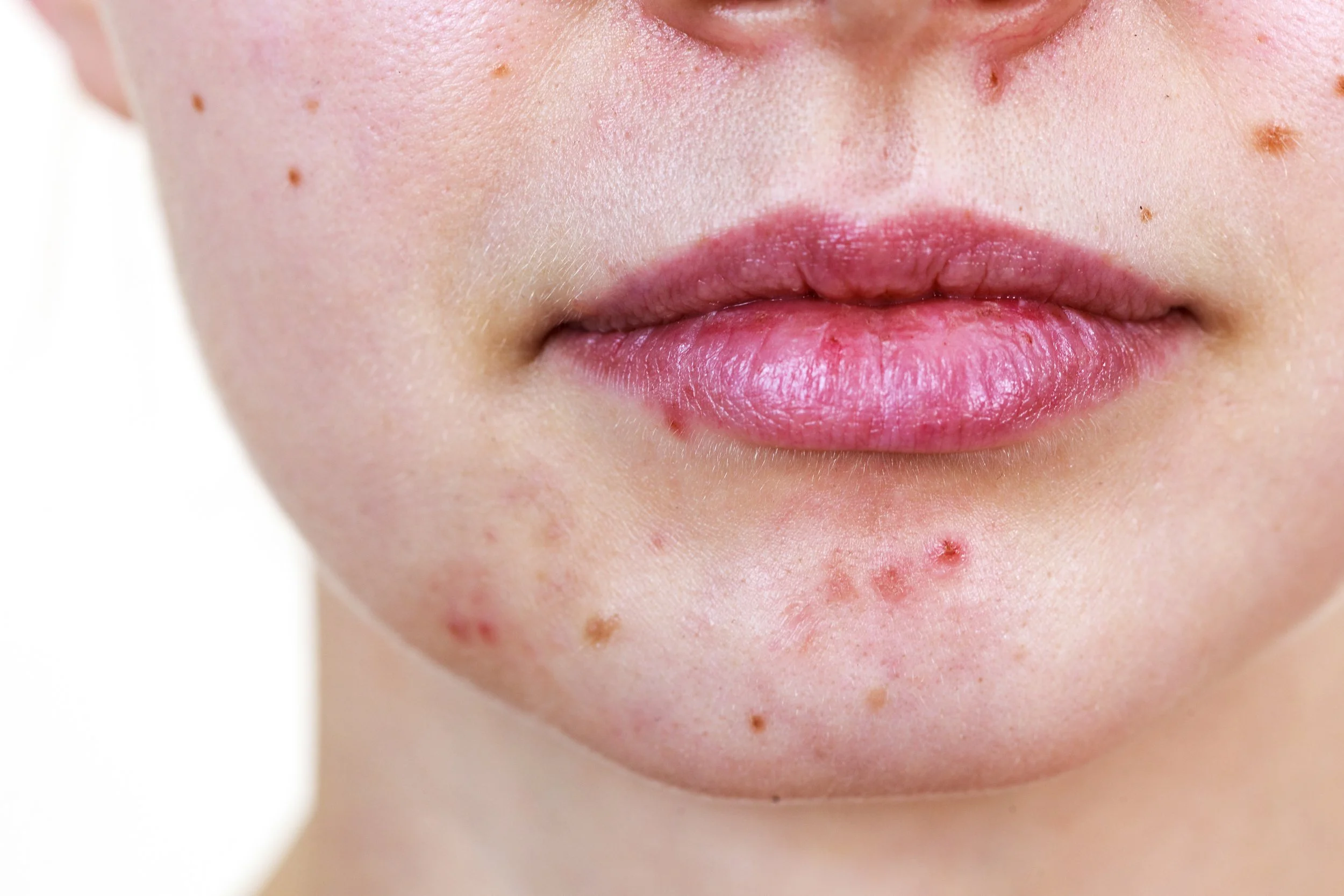 Understanding Acne Triggers