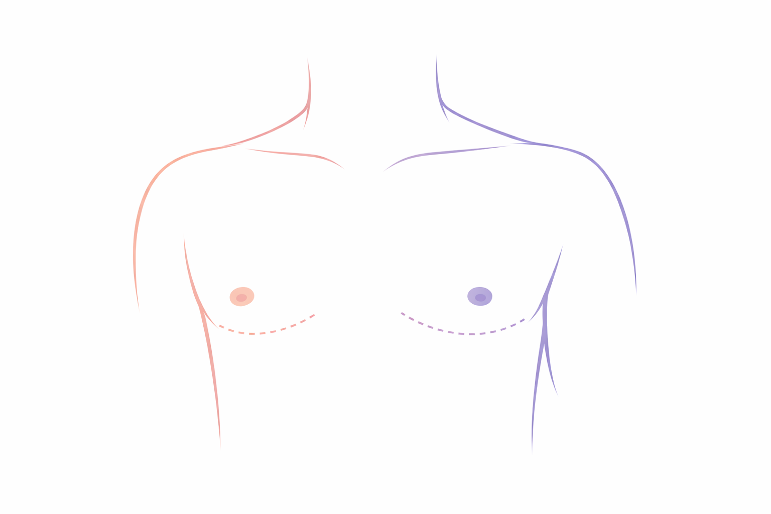 Line drawing of a woman's chest with two pairs of dotted lines indicating surgical incision sites, one on each breast, in pink and purple colors.