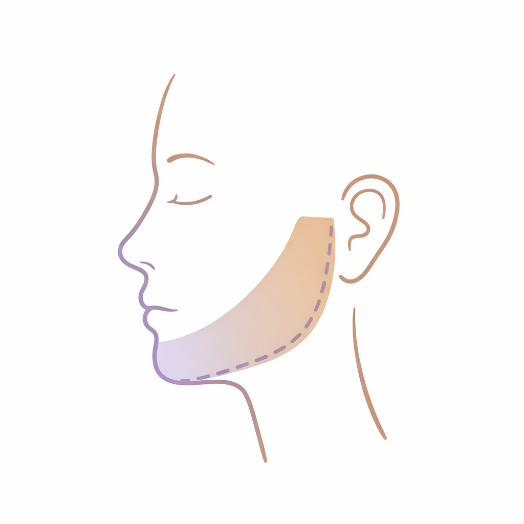 Side profile of a person's face with a shaded area of the jawline indicating a surgical or cosmetic treatment area.
