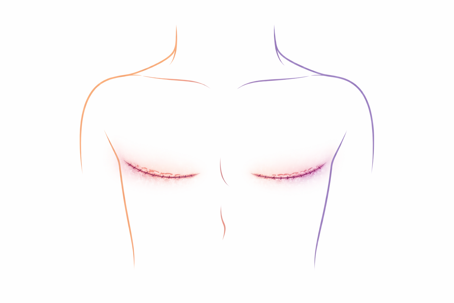 Illustration of a woman's chest with surgical scars under both breasts, faintly outlined in minimalist style with orange on the left and purple on the right.