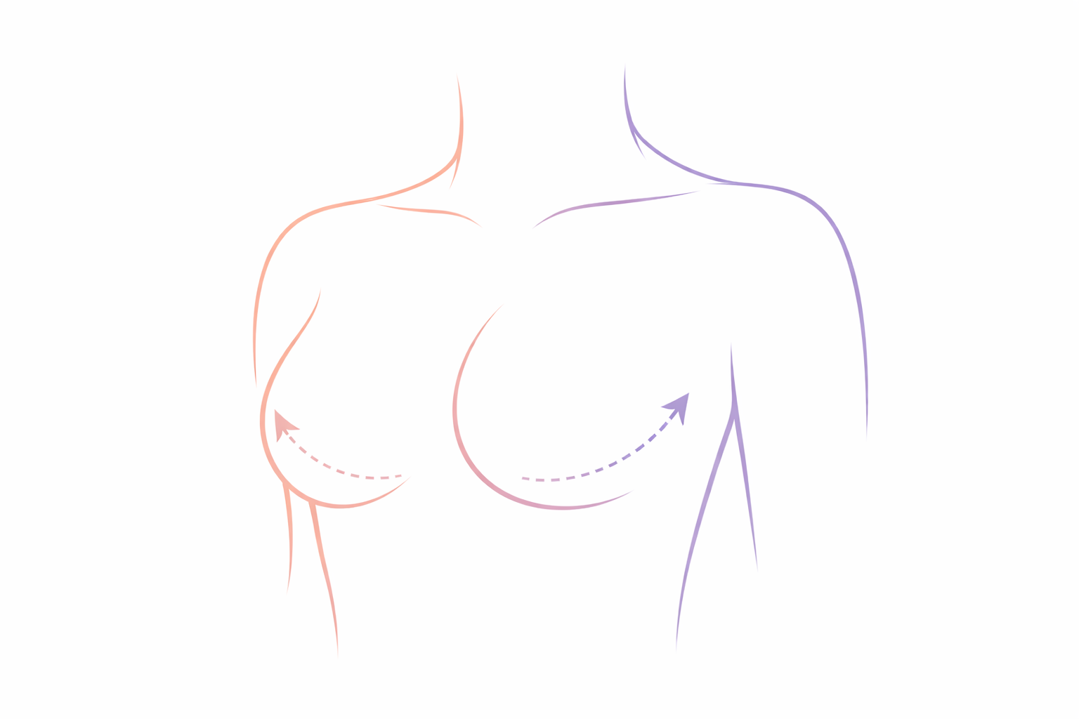Illustration of a female breast with dashed lines and arrows indicating lifting and shaping, with outlines of a woman’s upper body, using pink and purple lines.