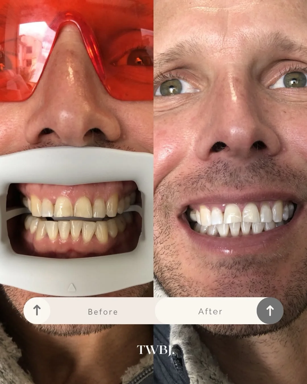 One session. A completely elevated smile ✨

Our client&rsquo;s first ever TWBJ treatment &mdash; achieving a noticeably whiter, brighter smile in just one sitting, along with that instant boost of confidence that comes with it. (Swipe across to see t