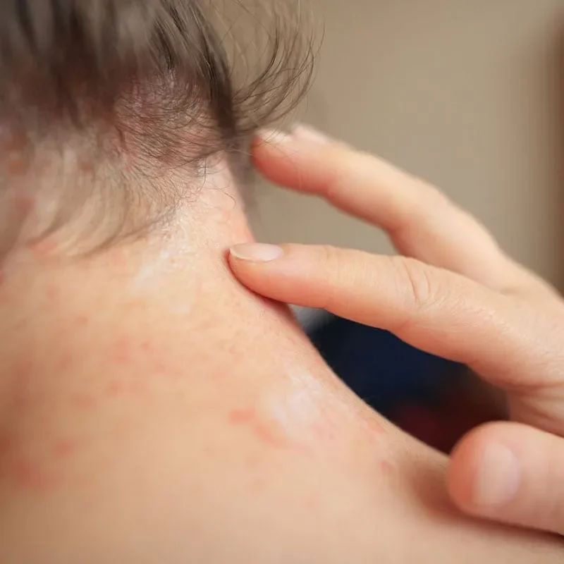 Eczema-Psoriasis-Cream02.webp