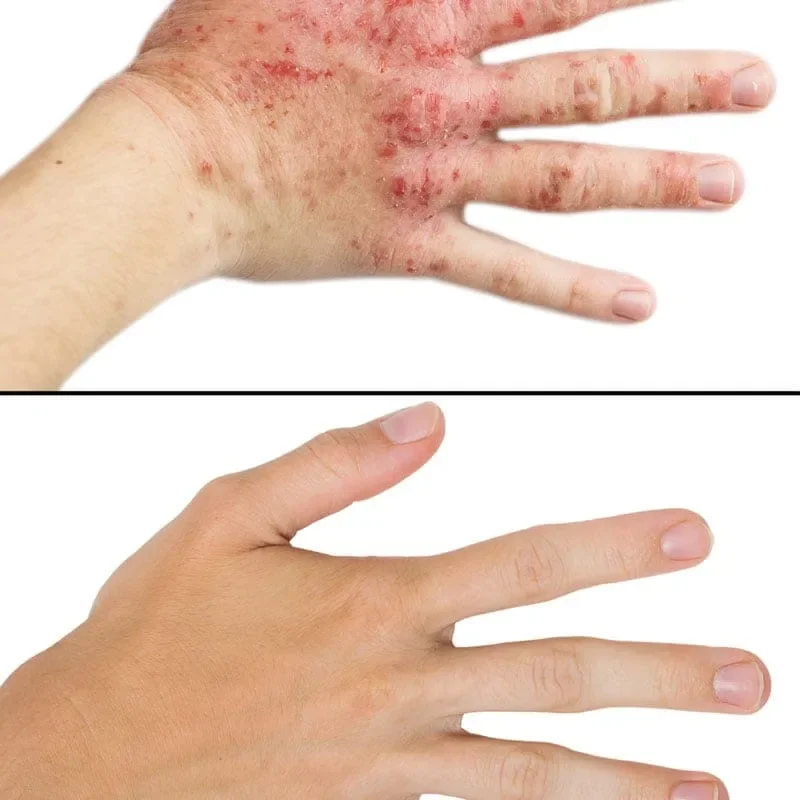 Eczema-Psoriasis-Cream01.webp