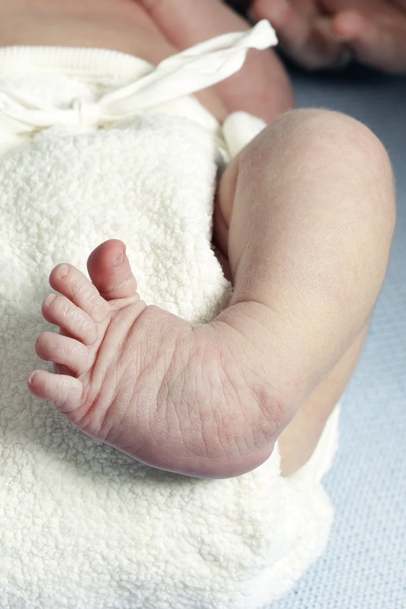 Close-up of a clubfoot in a young baby.