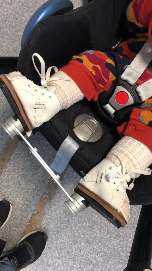 Child wearing a fixed abduction brace or boots and bar for Ponseti correction of clubfoot, sitting in a buggy.