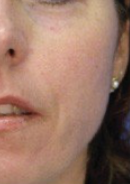 After Broadband Light Therapy 4.png
