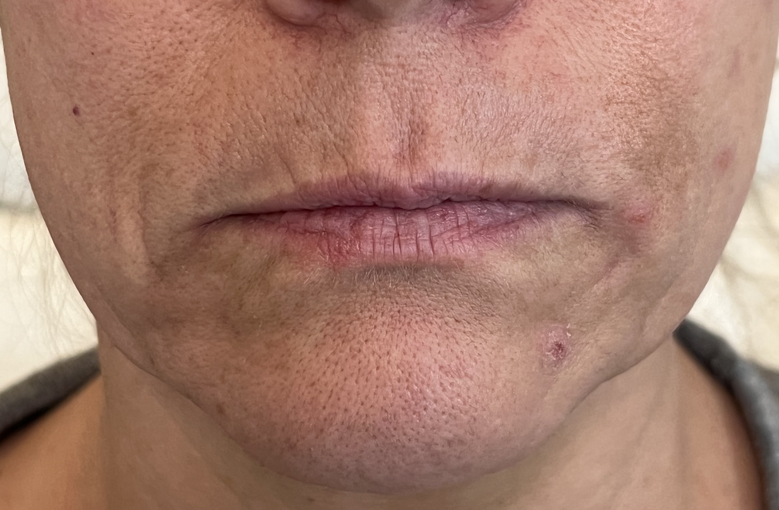 Before Lip Plump at House of Aesthetics in Cary, NC.png