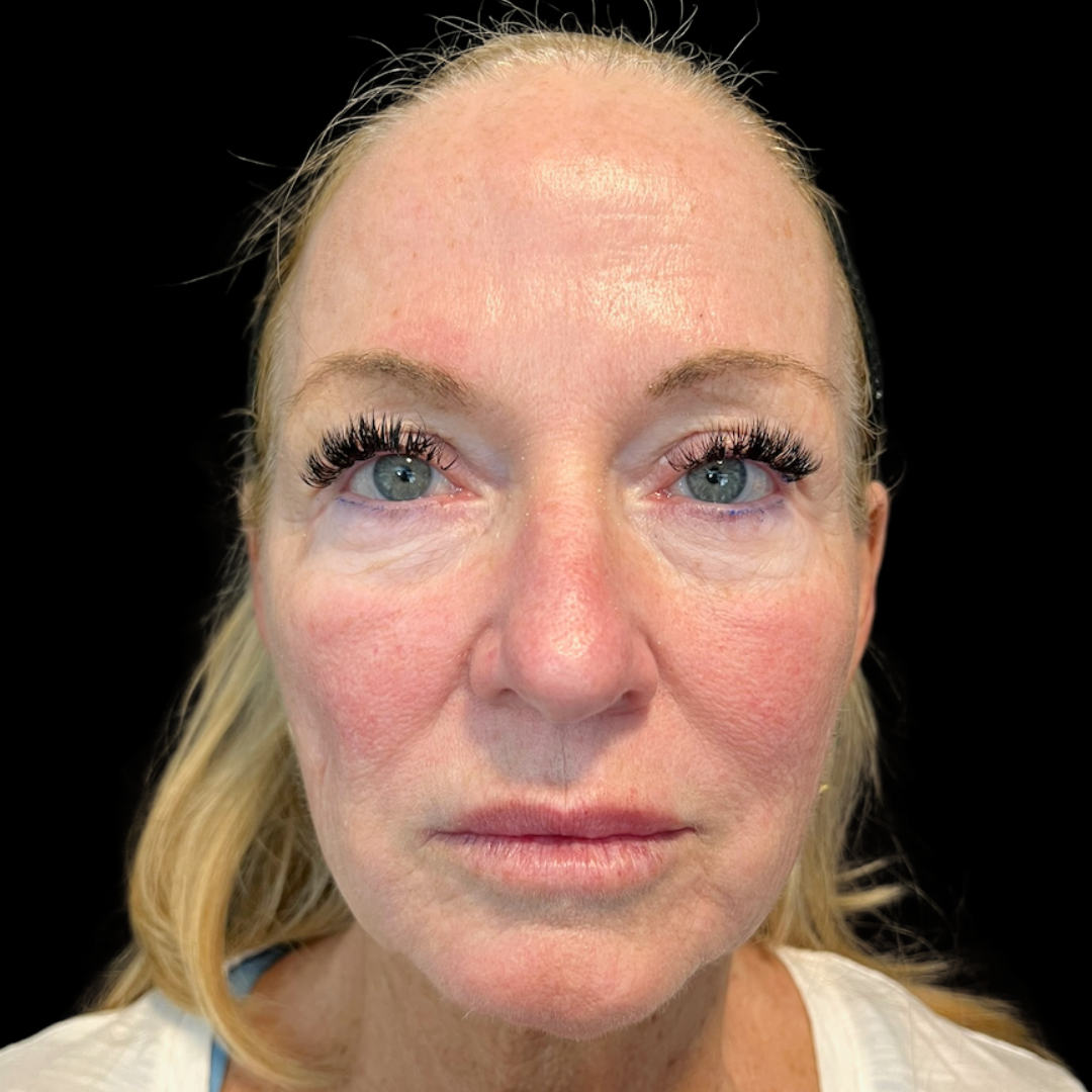 The art of enhancing and balancing the whole face with dermal filler at House of Aesthetics in Cary, NC